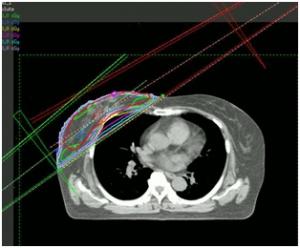 放射線治療計画立案の画像3