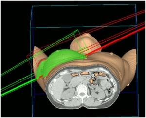 放射線治療計画立案の画像4