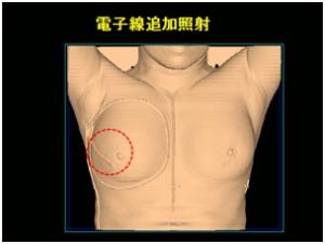 放射線照射実施。電子線追加照射