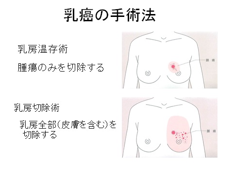乳がんの手術法のイラスト図解