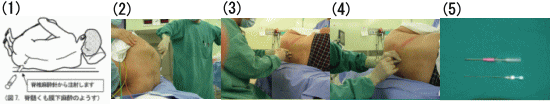 脊髄くも膜下麻酔の流れ説明写真
