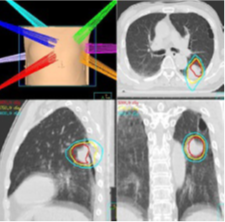 肺定位照射治療例1の画像