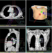 肺定位照射治療例2の画像