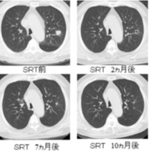 肺定位照射治療経過の画像