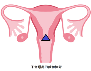 子宮頚部円錐切除術の画像2