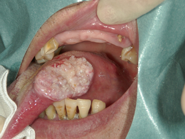 写真（1）舌がん