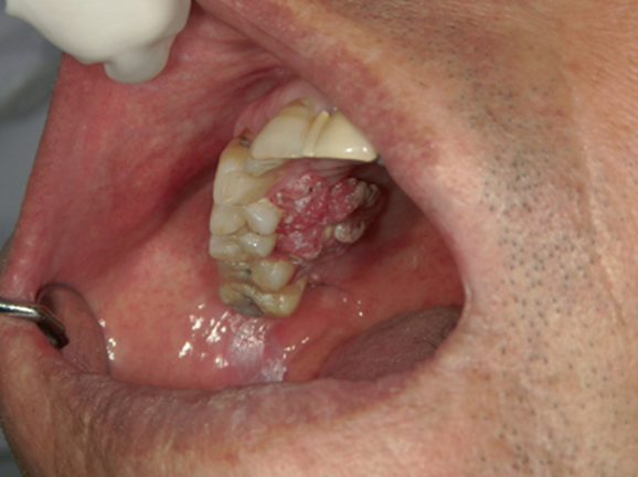 写真（2）上顎歯肉がん