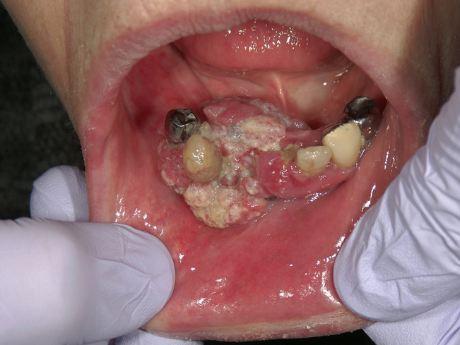 写真（3）下顎歯肉がん
