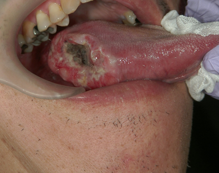 写真（7）右側舌がん（術前）