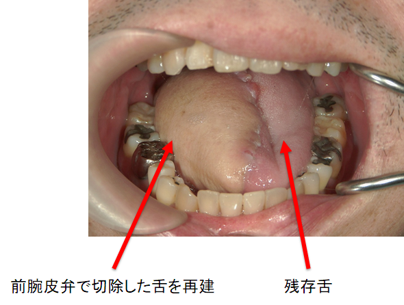 写真（7）右側舌がん（術後）