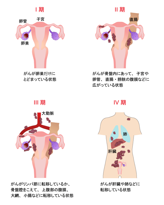 卵巣がんの広がり（進行期分類）の画像