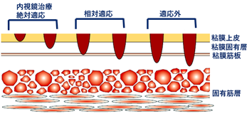 食道がんの治療の画像1