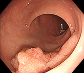 大腸がんの画像1