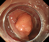大腸がんの画像2