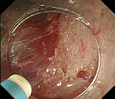 大腸がんの画像3