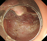 大腸がんの画像4