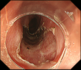 食道がんの治療の画像6