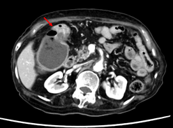 大腸がんの画像7