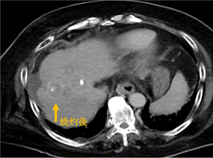 肝細胞がんの画像2