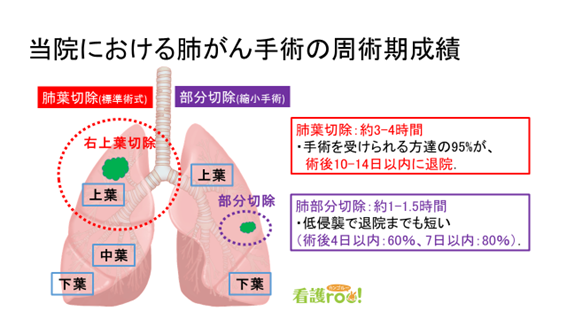 当院における肺がん手術の周術期成績