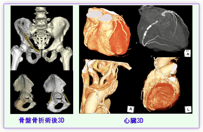 骨格骨折3D画像と心臓3D画像